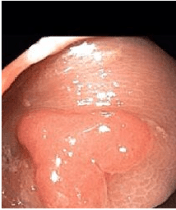 Heart-Shaped Polyp (from ACG twitter feed -recommends screening colonoscopy)