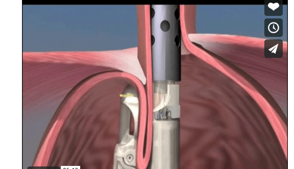 Transoral Fundoplication