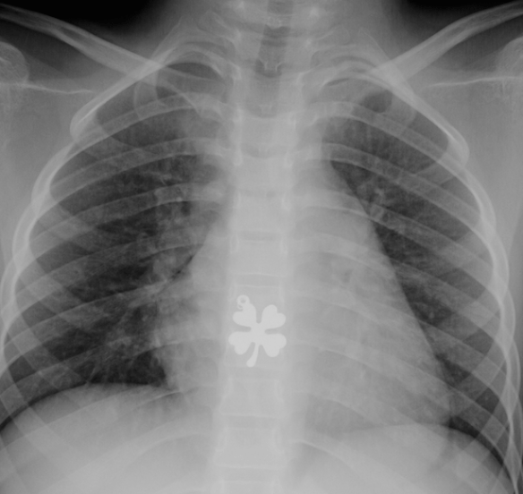 Esophageal 4-Leaf Clover Pendant