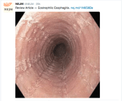 Esophagus with ringed appearance, furrowing, and loss of vascular markings