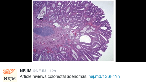 Colonic adenoma