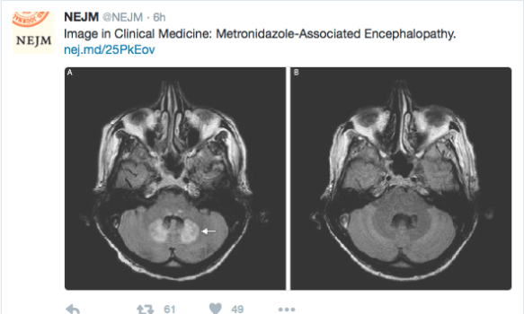 Flagyl Encephalopathy