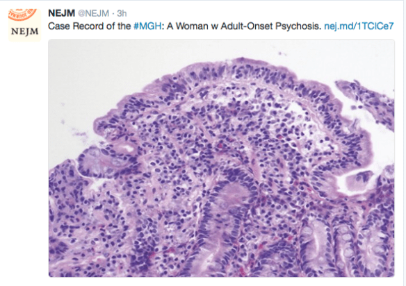 A representative case, associated with this figure of intestinal histology, of the complexity: a lady with psychosis associated with celiac disease is not adherent with her gluten free diet