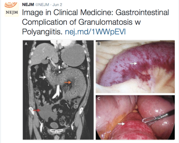 NEJM PicGI vasculitis