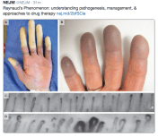A) Pallor phase B) Cyanotic phase C) Normal nailfold capillaries (primary phenomenon) D) Abnormal nailfold capillaries typical of microvascular disease